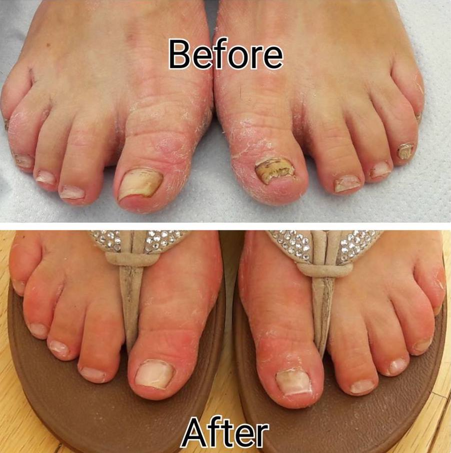 Nail Reconstruction The Foot Health Company